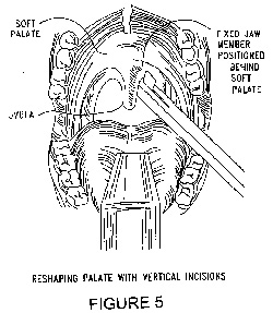 Reshaping Soft Palate